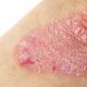 psoriasi cause rimedi