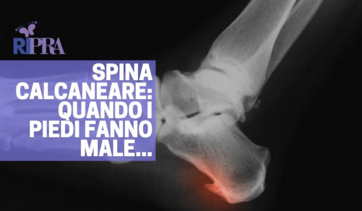 Spina calcaneare: quando i piedi fanno male...